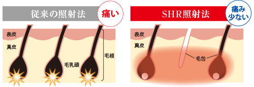 SHR（Super Hair Removal）方式採用で痛みが少ない、毛周期関係なし！